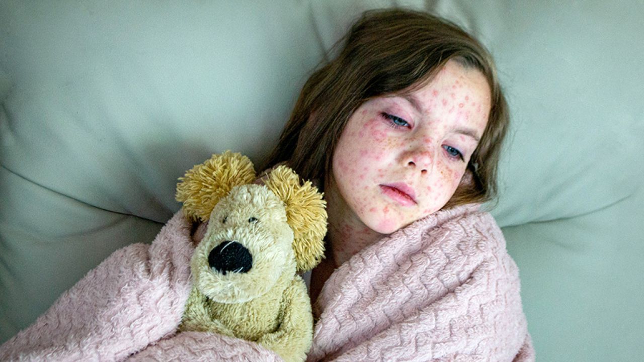 বিশ্বজুড়ে হামের ভয়াবহ প্রত্যাবর্তন, কারণ কী