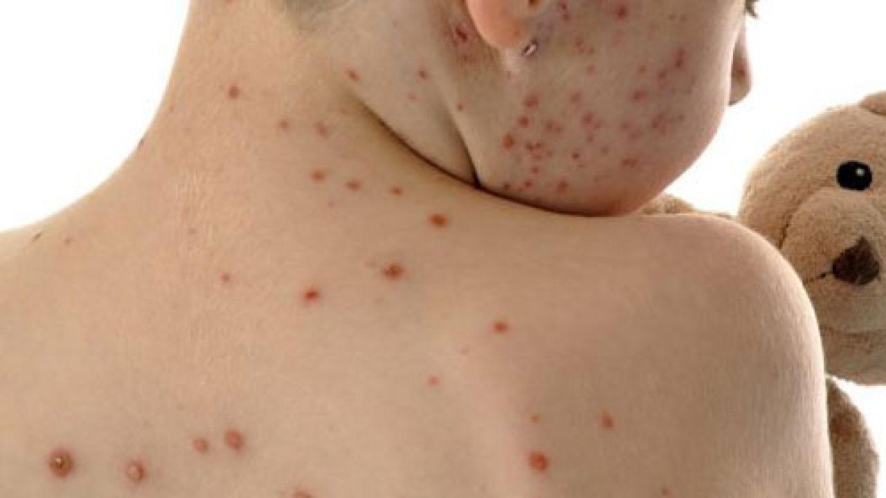 হাম থেকে মুক্ত থাকতে জানতে হবে যেসব বিষয়